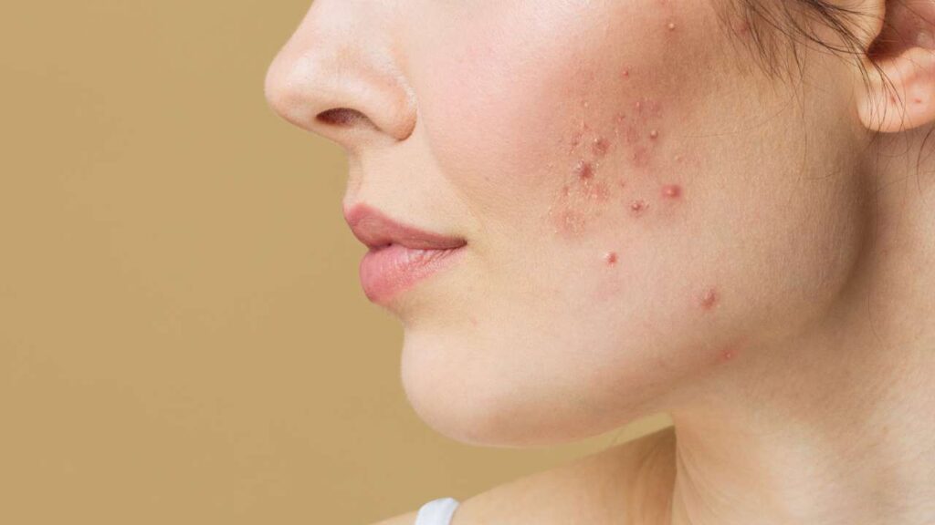 mujer con la piel llena de imperfecciones