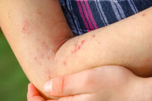 dermatitis por estrés