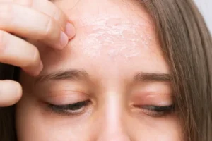 piel-irritada por estrés